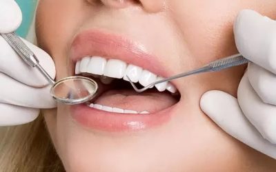 How dental veneers help to hide dental damage