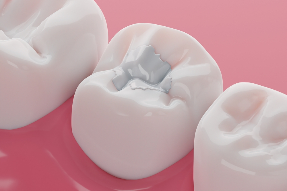 Composite Filling Procedure: Everything You Need to Know